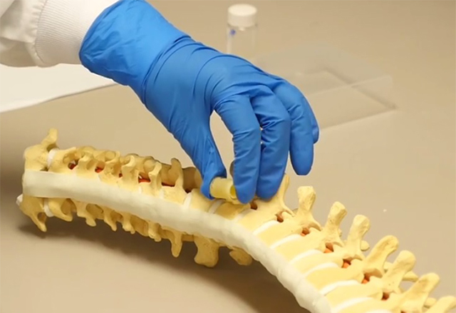 Нов порест материал помага за по-бързо и по-евтино възстановяване на гръбначния стълб