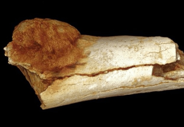 Най-старата следа от раково заболяване - преди 1.7 млн. години