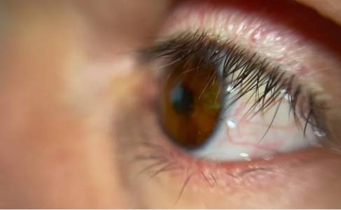 Пациент получи първото изцяло 3D принтирано око